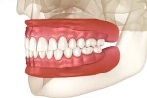 Removable,Prosthesis,,Artificial,Gum,And,Teeth.,Dental,3d,Illustration