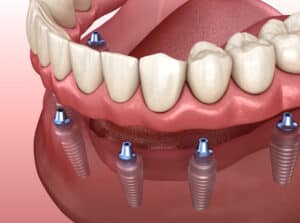 Mandibular,Prosthesis,With,Gum,All,On,6,System,Supported,By