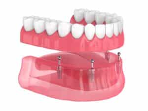 3d,Render,Of,All on 4,Removable,,Implants,Supported,,Overdenture,Installation,Over